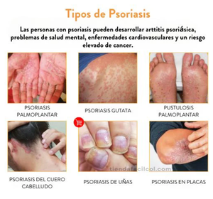 🌿✨Kolmax™ | ⛔️¡ADIÓS PICAZÓN! Tratamiento en aerosol para PSORIASIS 🌿